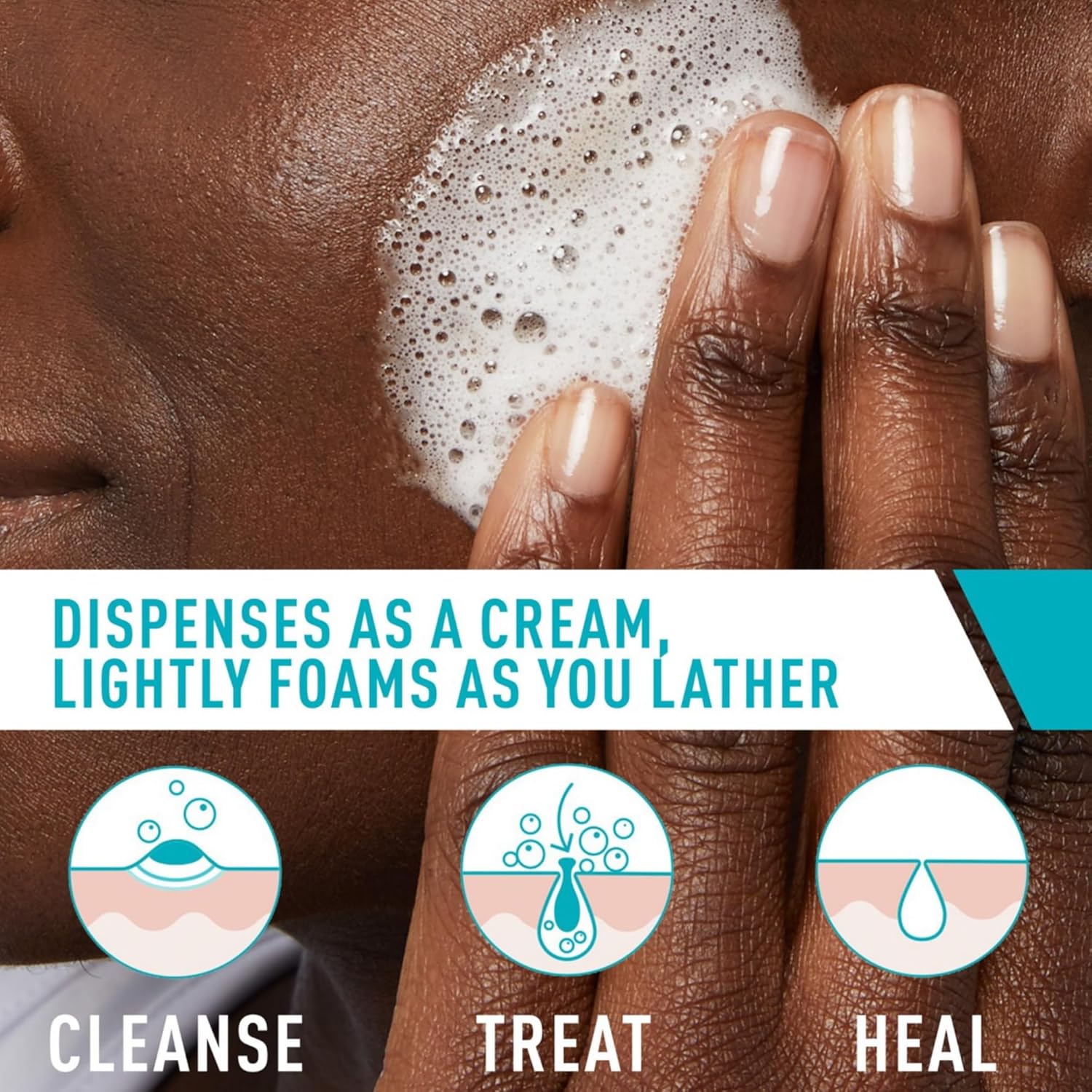 CeraVe Acne Foaming Cleanser – 4% Benzoyl Peroxide, Daily Face Wash