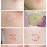 Invisible Acne Stickers