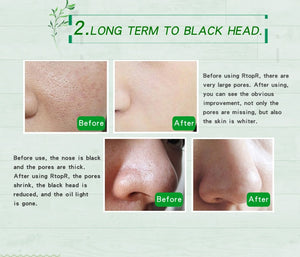 Mango Removing Black Head Face Mask